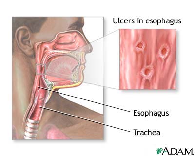 Herpetic esophagitis