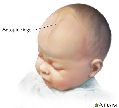 ridge metopic suture forehead line bone frontal ridging two medlineplus overview symptoms halves ency