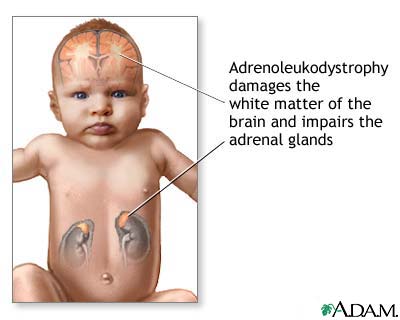 Neonatal adrenoleukodystrophy