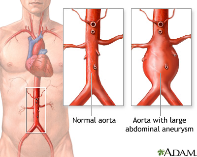 Abdominal Aortic Aneurysm Medlineplus Medical Encyclopedia