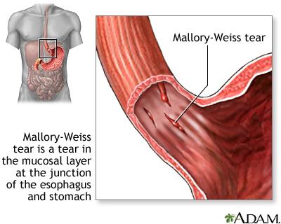 Mallory-Weiss tear