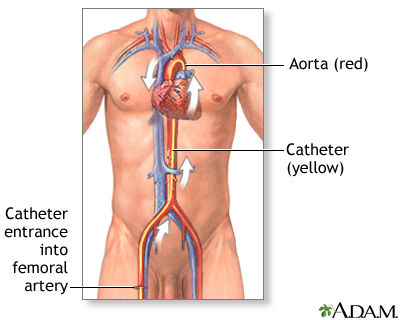 komen Me kabel Coronary artery balloon angioplasty - series—Procedure, part 1: MedlinePlus  Medical Encyclopedia