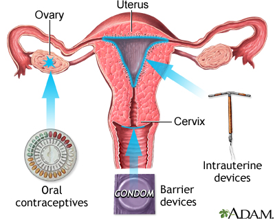 Applicator of the System Planning. The ring is attached to the cervix... |  Download Scientific Diagram