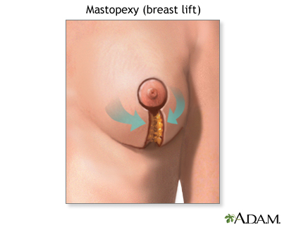 Breast lift (mastopexy) - series—Procedure: MedlinePlus Medical Encyclopedia