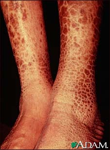 Ichthyosis, acquired - legs
