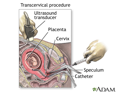 Procedure, part 2 - transcervical