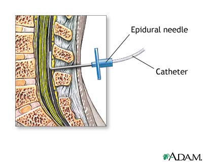 Where Does Epidural Needle Go In Lower Back Pain From Epidural Years