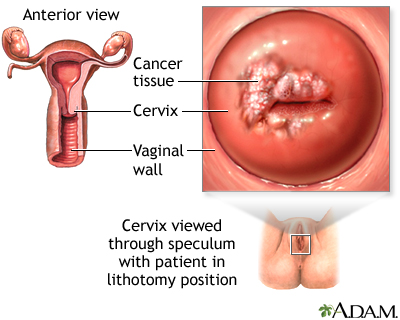 Cervical Cancer Medlineplus Medical Encyclopedia