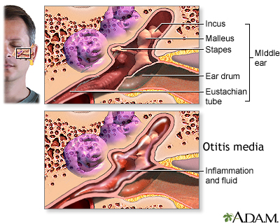 Middle Ear Infection otitis Media MedlinePlus Medical Encyclopedia Image Middle Ear Infection otitis Media MedlinePlus Medical Encyclopedia Image