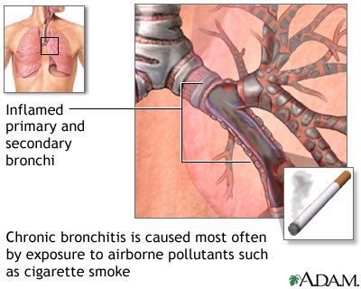 Causes of chronic bronchitis: MedlinePlus Medical ...