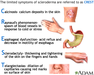 CREST syndrome: MedlinePlus Medical Encyclopedia Image