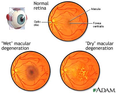 Időskori makula degeneráció (AMD = Age-related Macular Disease)
