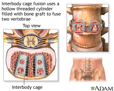 Interbody cage fusion
