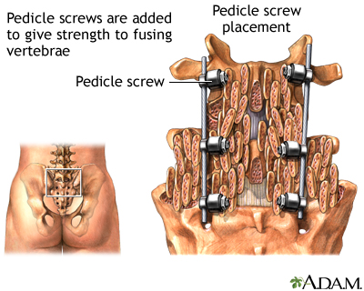 Pedicle screw