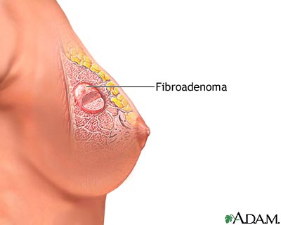Fibroadenoma: MedlinePlus Medical Encyclopedia Image