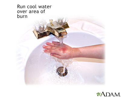 Minor burn treatment - run under cool water
