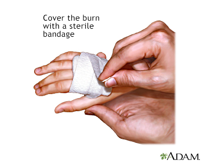 Minor burn treatment - apply bandage