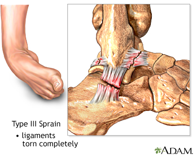 Type III ankle sprain