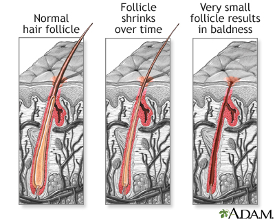 Hair follicle: MedlinePlus Medical Encyclopedia Image