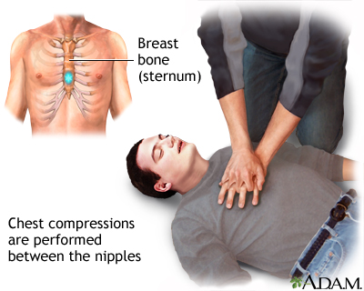 Chest compressions