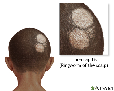 Ringworm of the scalp