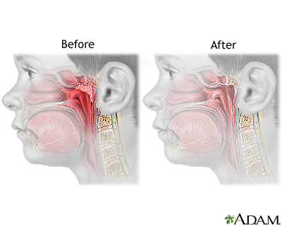 Adenoid Removal Series Aftercare MedlinePlus Medical Encyclopedia