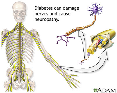 Diabetes and nerve damage