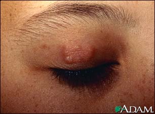 Granuloma annulare on the eyelid