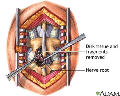 Microdiscectomy - Procedure