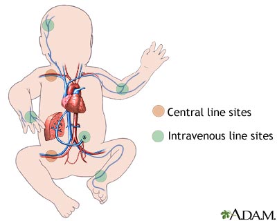 Intravenous fluid sites