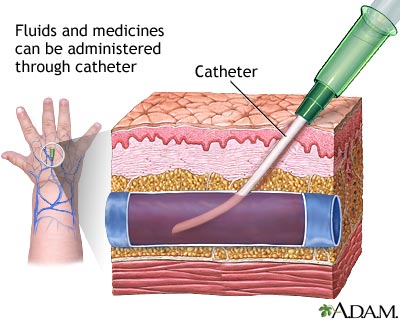 Peripheral Intravenous Line MedlinePlus Medical Encyclopedia Image Peripheral Intravenous Line MedlinePlus Medical Encyclopedia Image