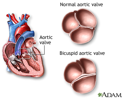 Bicuspid Aortic Valve Medlineplus Medical Encyclopedia