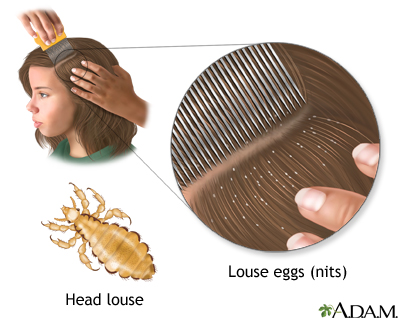 Head lice: MedlinePlus Medical Encyclopedia