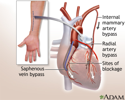 Heart bypass surgery - series—Procedure, part 3: MedlinePlus Medical