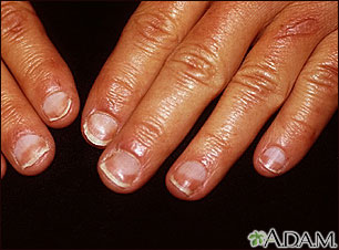 Half and half nails: MedlinePlus Medical Encyclopedia Image