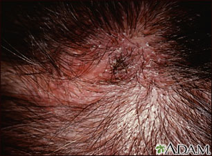 Ringworm of the scalp - Stock Image - C056/1137 - Science Photo Library