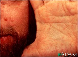 Basal cell nevus syndrome - face and hand