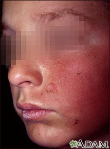 Dermatitis - contact on the cheek
