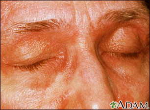Dermatomyositis - heliotrope eyelids