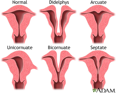 Congenital uterine anomalies