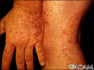 Ringworm - tinea on the hand and leg