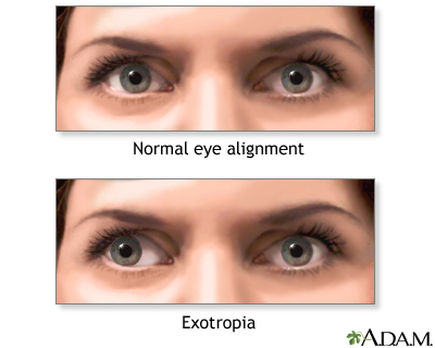 Exotropia