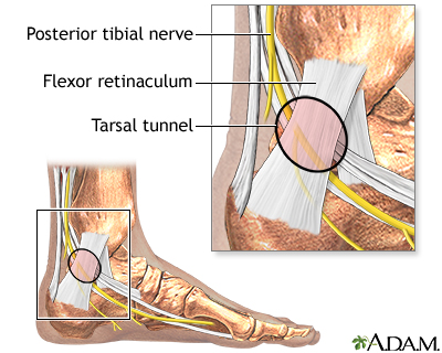 Tarsal Tunnel