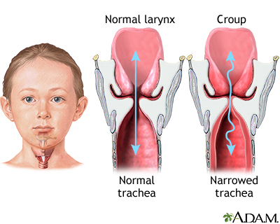 Croup