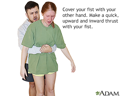 Perform abdominal thrusts