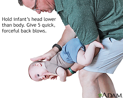 Infant is choking – give back blows