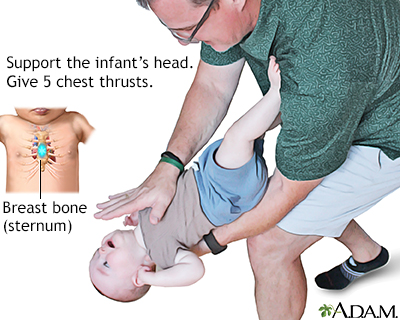 Object does not come out – do chest thrusts