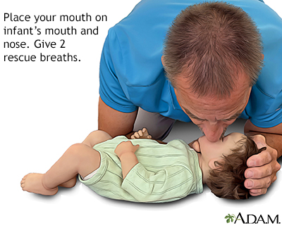 Infant is not breathing