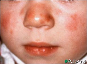 Lupus - discoid on a child's face
