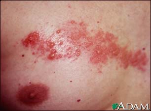 Herpes zoster (shingles) on the chest